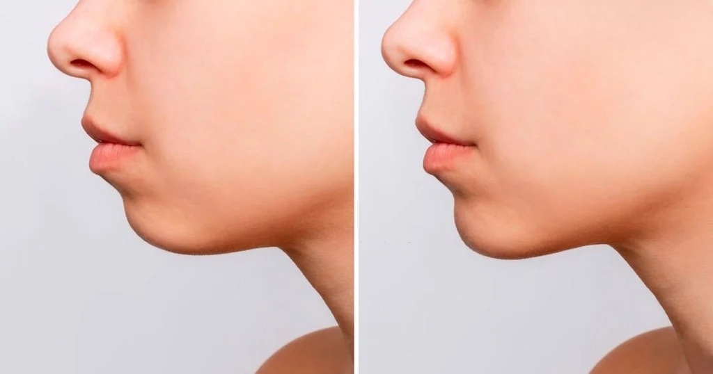 cằm lẹm là gì
